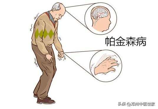 帕金森最新治疗方法，希望之光引领人生舞台新篇章