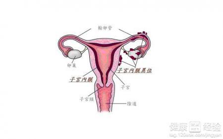 子宫腺肌瘤最新最佳治疗方法揭秘